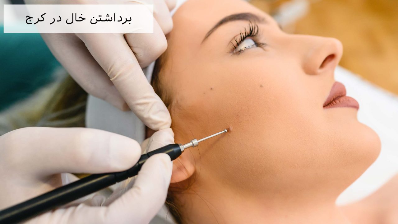 برداشتن خال در کرج