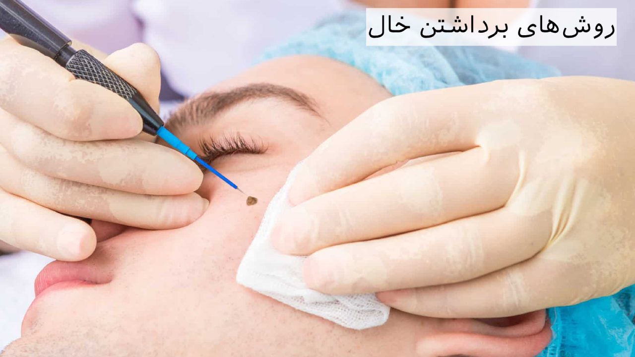 روش_های برداشتن خال