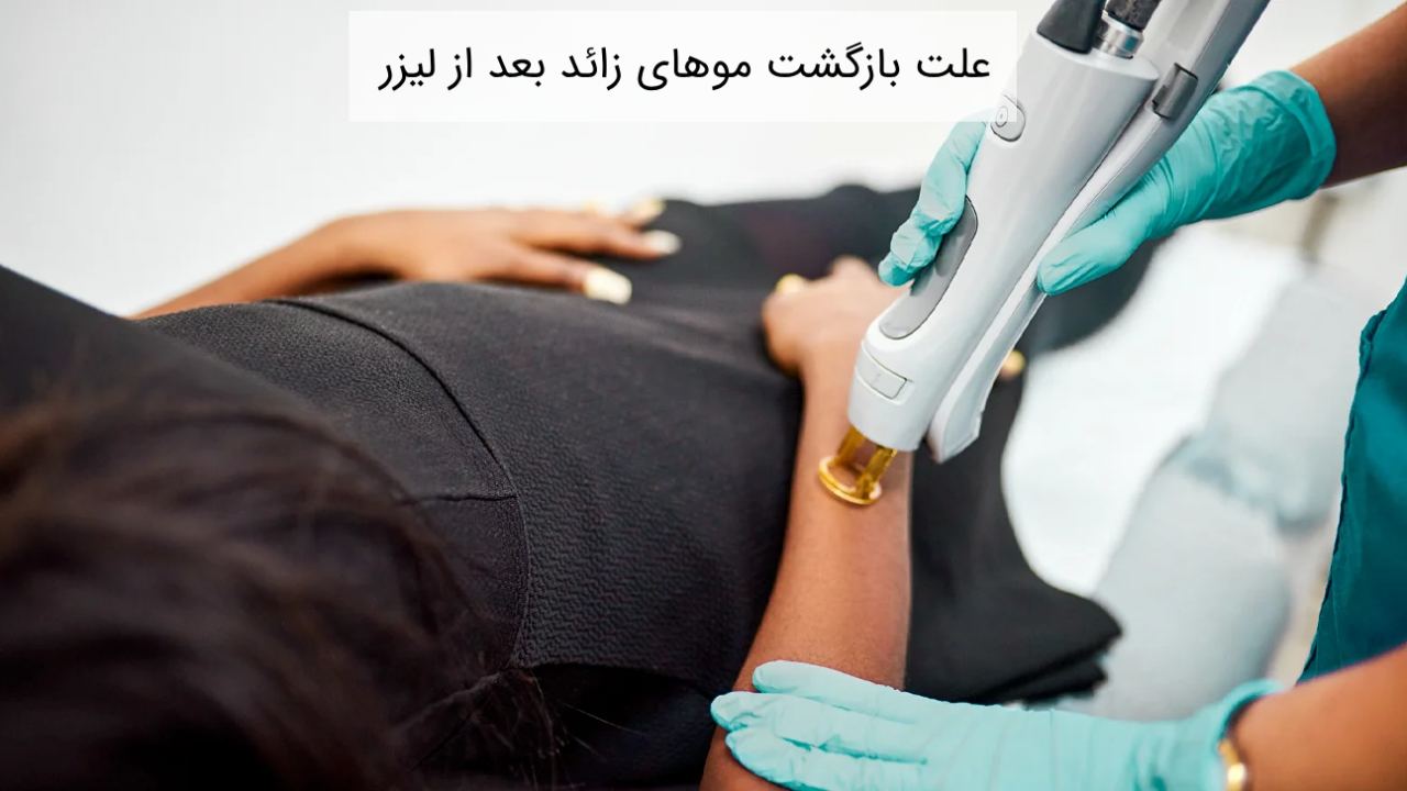 علت بازگشت موهای زائد بعد از لیزر